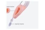 Camjoy VM101 Video Laryngeal Mask detail image 3